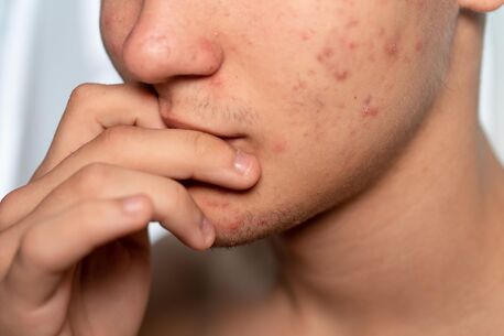 New York, Health, Deep Clean Start For Breakout-Prone Skin