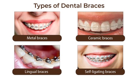 Noida, Dental, Braces Near Me