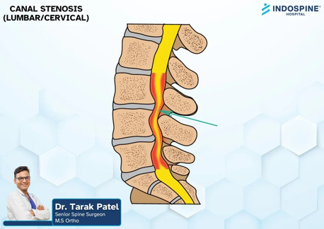 Ahmedabad, Health, Canal Stenosis Treatment In Ahmedabad | Spine Specialist Ahmedabad