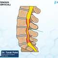 Canal Stenosis Treatment In Ahmedabad | Spine Specialist Ahmedabad