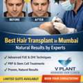 Best Hair Transplant In Mumbai &ndash; Book Expert Consultation Today