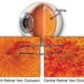 Comprehensive Solutions For Retinal Circulatory Problems
