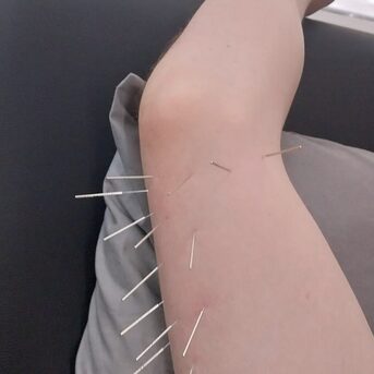 Sydney, Health, Dry Needling Near Me For Pain Relief | Strength Clinic