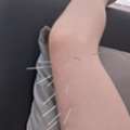 Dry Needling Near Me For Pain Relief | Strength Clinic