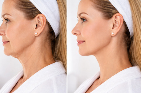Dubai, Health, Body HIFU Dubai: Price, Benefits & Non-Surgical Face Lift Treatment