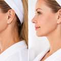 Body HIFU Dubai: Price, Benefits & Non-Surgical Face Lift Treatment