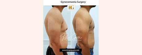 Mumbai, Health, Is Gynecomastia A Big Surgery? What You Should Really Expect
