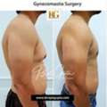 Is Gynecomastia A Big Surgery? What You Should Really Expect