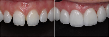 Dublin, Dental, Implant Dentistry For Strong & Natural Tooth Replacement | Dublin Metro Dental