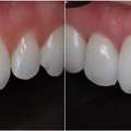 Implant Dentistry For Strong & Natural Tooth Replacement | Dublin Metro Dental