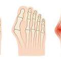 What Are The Advantages Of Non-Invasive Bunion Surgery?
