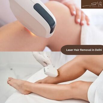 New Delhi, Health, Affordable Laser Hair Removal In Delhi With Expert Consultation