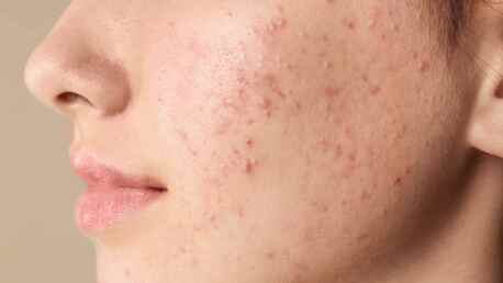 New Delhi, General, Get Clear, Smooth Skin With Advanced Acne Scar Treatment Delhi