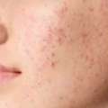 Get Clear, Smooth Skin With Advanced Acne Scar Treatment Delhi