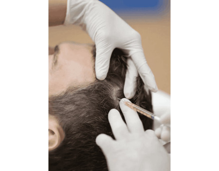 Milan, Health, PRP Capelli Albania: Trattamento Avanzato A Tirana Per Ricrescita Naturale