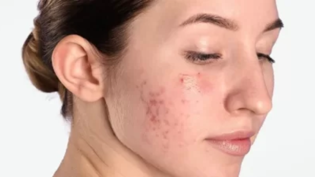 New York, Health, Lightweight Clarifying Serum For Breakout-Prone Skin