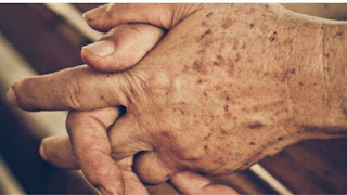 Bukit Timah, Beautician, Singapore Freckle Treatment By Lim Clinic And Surgery.