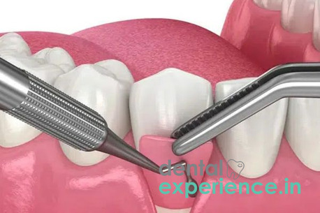 Kerala, Dental, Periodontal Flap Surgery &mdash; Kochi Ernakulam