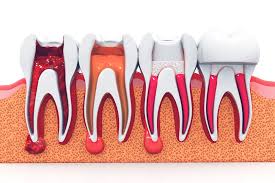 Lucknow, Dental, Best Root Canal Treatment In Gorakhpur