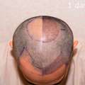 Best Hair Transplant Clinic Manchester - Book Your Free Consultation Today