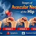Stages Of Avascular Necrosis Hip &ndash; Symptoms & Treatment