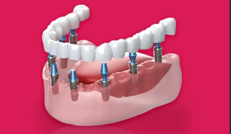 Gurgaon, Dental, Dental Implant In Gurgaon &ndash; Cost, Procedure, And Why It&rsquo;s The Best Choice