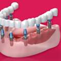 Dental Implant In Gurgaon &ndash; Cost, Procedure, And Why It&rsquo;s The Best Choice