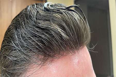 New York, Medical, Non-Surgical Hair Restoration In California