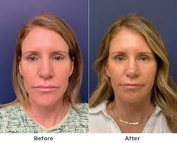 New Delhi, Health, Achieve Youthful Radiance With Non-Surgical Facelift In Rajouri Garden
