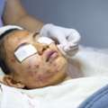 Advanced Acne Scar Treatment In Dubai For Clear & Healthy Skin