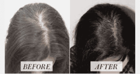 New York, Health, PRP For Hairloss NYC