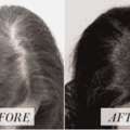 PRP For Hairloss NYC