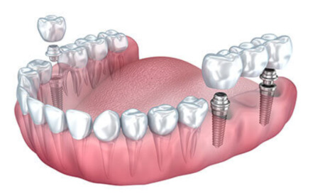 Gurgaon, Dental, Dental Implant In Gurgaon &ndash; Transform Your Daily Life Easily