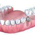 Dental Implant In Gurgaon &ndash; Transform Your Daily Life Easily