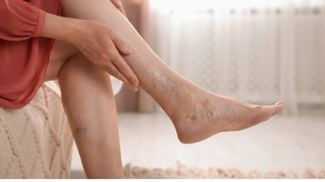 Mumbai, Health, Safe & Minimally Invasive Treatment For DVT