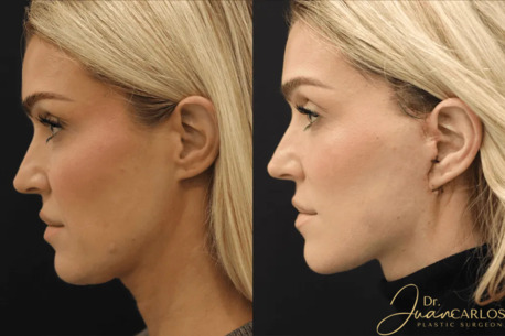 Dubai, Health, Mini Face Lift | Botched Mini Face Lift