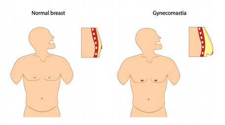 New Delhi, Health, Gynecomastia Surgery In Delhi- Get Rid Of Male Chest Fat