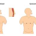 Gynecomastia Surgery In Delhi- Get Rid Of Male Chest Fat