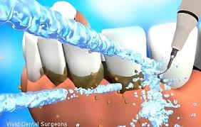 Singapore, Dental, Aesthetic Amplification: The Art Of Scaling And Polishing