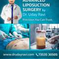 Advanced Liposuction Surgery By Dr. Uday Ravi &ndash; Precision You Can Trust
