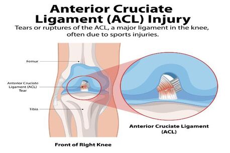 Manchester, Medical, ACL Injury Treatment By Specialist Knee Surgeon | Expert Care Near Manchester