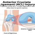 ACL Injury Treatment By Specialist Knee Surgeon | Expert Care Near Manchester