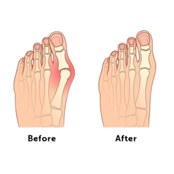 Houston, Medical, Advanced Bunion Surgery In Houston For Lasting Pain Relief