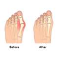 Advanced Bunion Surgery In Houston For Lasting Pain Relief