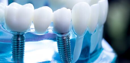 Mumbai, Dental, Affordable Dental Implant Treatment In Mumbai