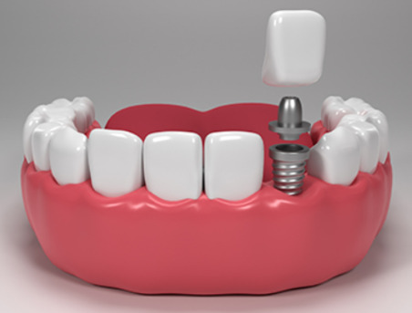 Gurgaon, Dental, Dental Implant In Gurgaon &ndash; See The Real Smile Transformation