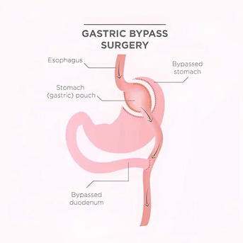 Ahmedabad, Health, Gastric Bypass Surgery Procedure In Ahmedabad - Weight Loss Procedure In Ahmedabad