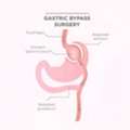Gastric Bypass Surgery Procedure In Ahmedabad - Weight Loss Procedure In Ahmedabad