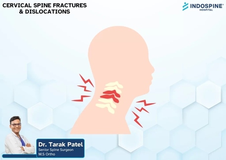 Ahmedabad, Health, Cervical Spine Fracture Treatment Specialist Ahmedabad | Expert Spine Care
