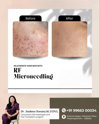 Visakhapatnam, Health, Benefits Of Microneedling- Derma One Clinic